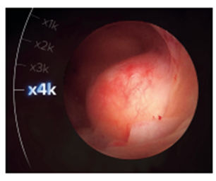子宮内膜ポリープの写真